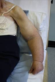 Figure 6 – Lymphoedema of the arm following treatment for breast cancer